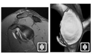 Bony Bankart on MR Arthrogram (left) and CT scan (right)