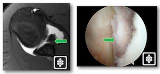 Bony Bankart on MR Arthrogram (left) and Arthroscopy (right)