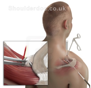 Suprascapular Nerve Palsy | ShoulderDoc