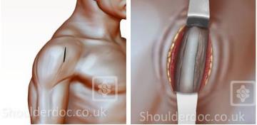 Biceps Tenodesis | ShoulderDoc