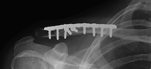 Clavicle Fractures | ShoulderDoc