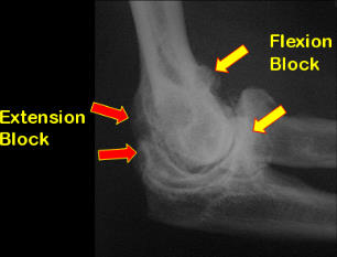 Causes of flexion and extension stiffness in arthritis