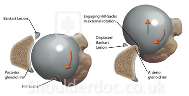 Hill Sac Lesion