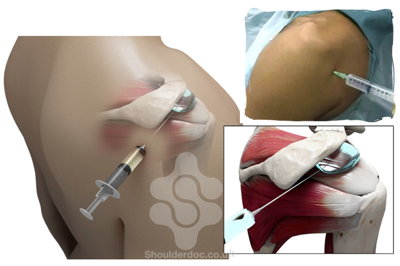 Steroid injection in deltoid