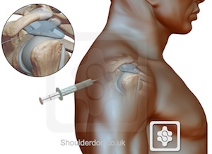 Posterior shoulder steroid injection technique