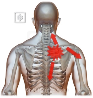 Interscapular Pain | ShoulderDoc