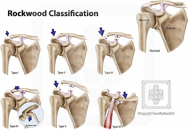 AC Joint Classifications |
