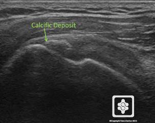 Steroid injection into shoulder muscle