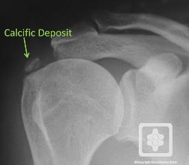 Calcific Tendonitis | ShoulderDoc