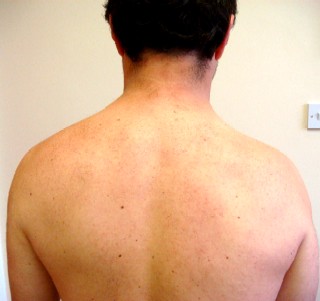 Trapezius muscle wasting on right side