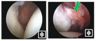 ALPSA (Anterior Labral Periosteal Sleeve Avulsion) seen at arthroscopy. On the left the anterior glenoid labrum is abscent. On the right the scope is in the anterosuperior portal and the labrum can be seen to be displaced and healed medially on the glenoid neck.