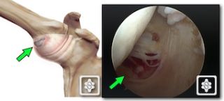 HAGL - Humeral Avulsion of Glenohumeral Ligament. A tearing of the capsule off the humerus with shoulder dislocations. The image on the right shows the HAGL as seen at arthroscopic surgery.
