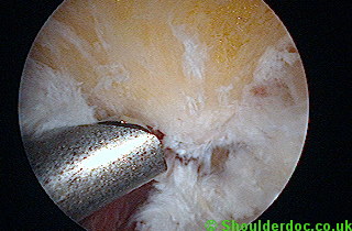 Excising spur with a burr. To appreciate the scale the burr is 4.5mm in diameter, so the spur is about 1.5cm size.