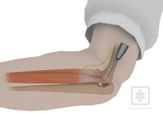 Steroid injection after shoulder surgery