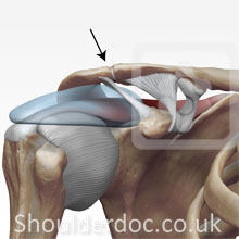 ACJ Arthritis