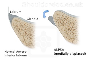 alpsa normal