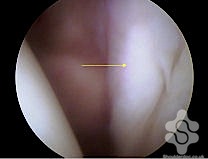 Large anterior labrum