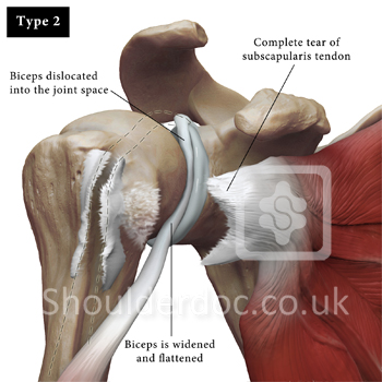 biceps%20dislocation%20type%202%20web.jp