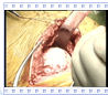 Humeral Head Preparation