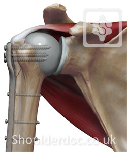 Greater Tuberosity Fractures