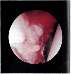 Fig A: Bleeding from a Bankart lesion following examination under anaesthetic can be controlled by lavage.