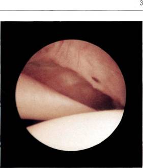 Figure C: The rolled mature edge of a rotator cuff tear next to the long head of the biceps tendon.