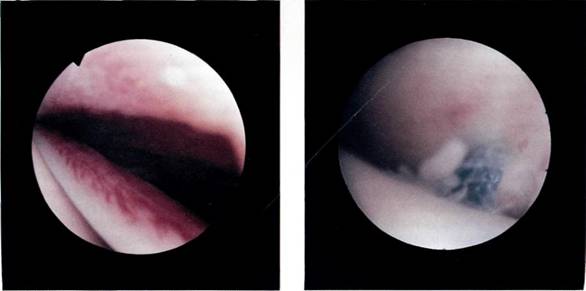 Figure G: Inflammation of a partial thickness rotator cuff tear seen above an equally inflamed biceps tendon.