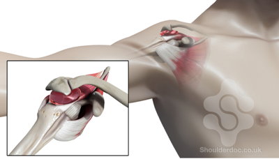 Injections For Rotator Cuff Disease Shoulderdoc