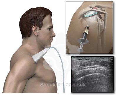 Shoulder steroid injection technique