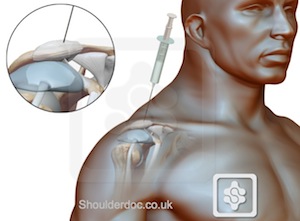 Subacromial injection of steroid