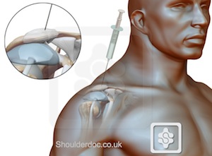 Frozen shoulder steroid injection technique