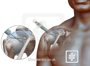 Subdeltoid bursitis steroid injection