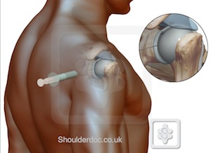 Epidural steroid injection shoulder pain