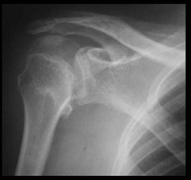 AP view showing the dislocation