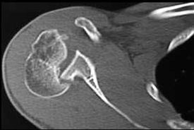 CT scan showing the defect with the glenoid locking into it.