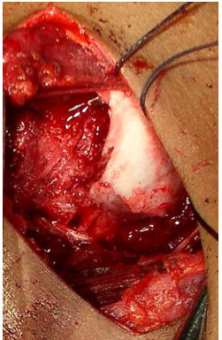 View from the front. Large defect just lateral to the articular margin which is to the right of the image.