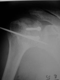 Immediate postoperative Xray. Note the  4mm cancellous screws fixing the graft in the defect and the transfixing Kwire. (Osteotomy fixation not included in this xray)