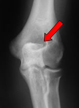 Inferior Calcaneal Spur