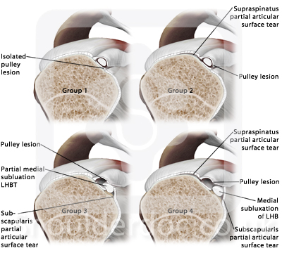Biceps tendon classifications | ShoulderDoc