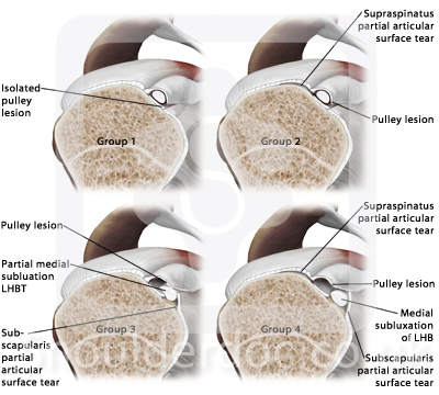 pulley%20lesions%20habermeyer%202004%20w