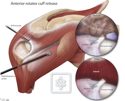 Arthroscopic Rotator Cuff Repair Technique