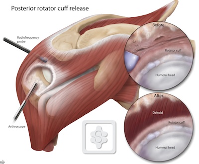 Arthroscopic Rotator Cuff Repair and Bicep Tenodesis: Right