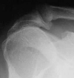 Acromial bone spur seen on x-ray