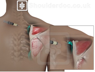 Articulatia scapulohumerala (umarul) | Anatomie si fiziologie