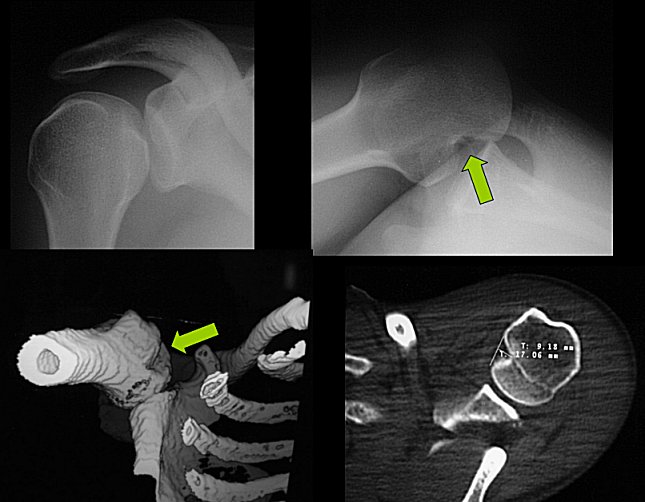 Axillary x-ray showing large reverse Hill-Sachs lesion (click on image for ...