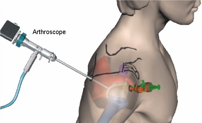 Shoulder-Arthroscope